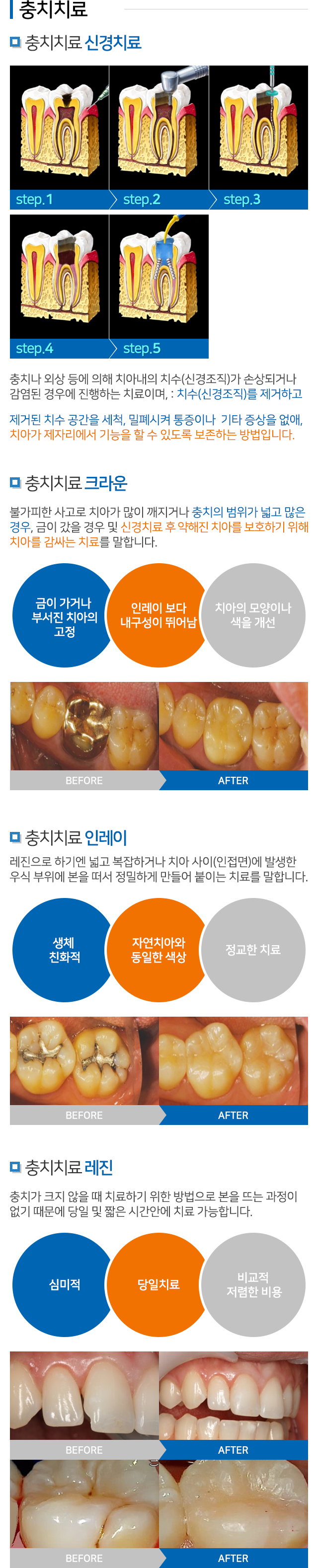 충치치료 설명 01