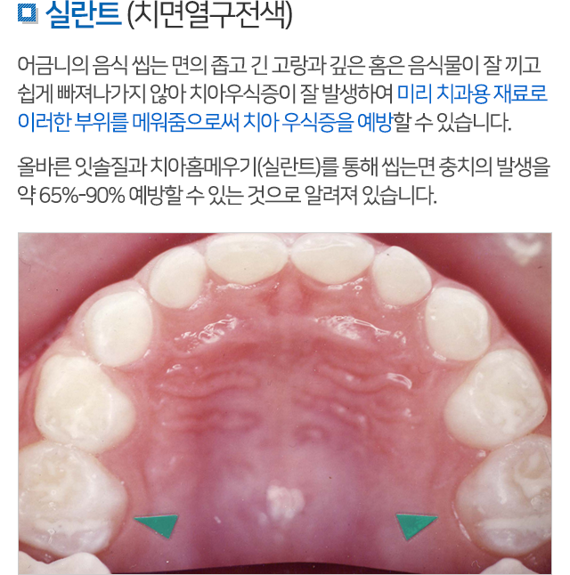 소아치과 설명 02