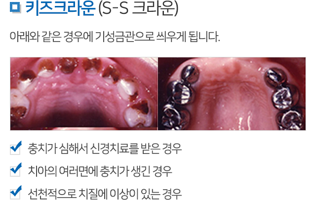 소아치과 설명 04