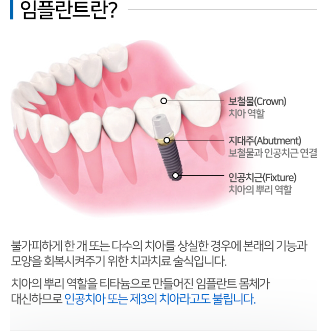 임플란트 설명 01