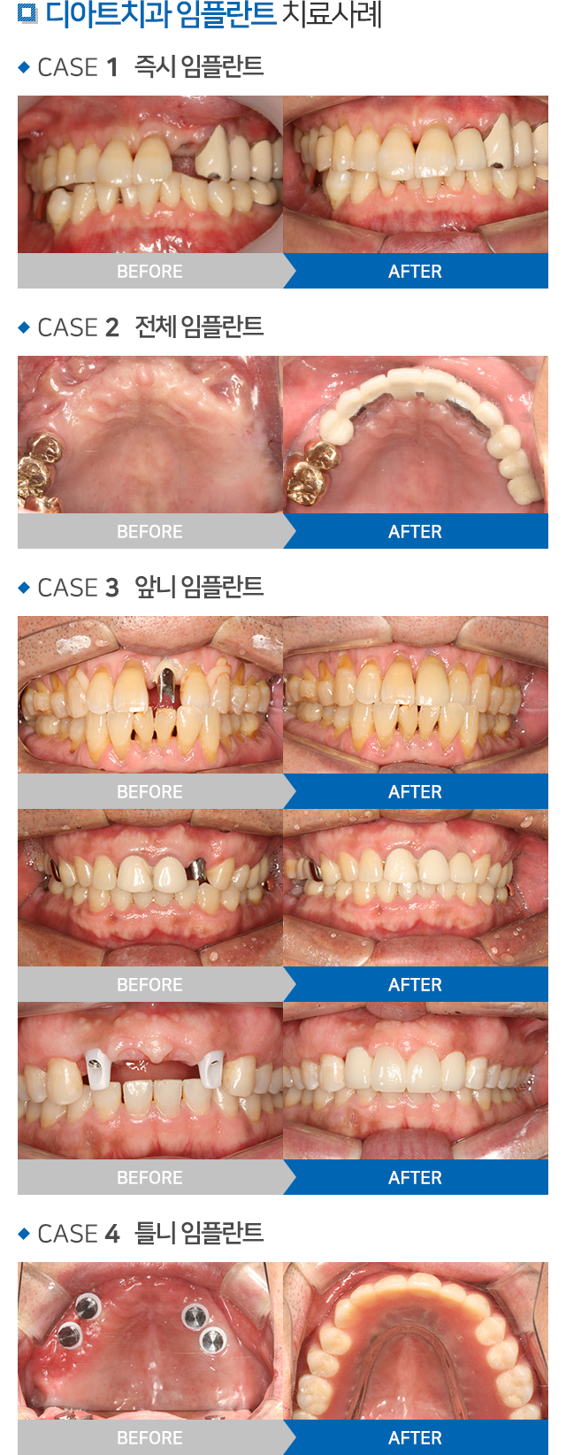 임플란트 설명 02