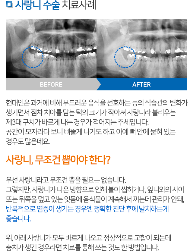 사랑니발치 설명 02