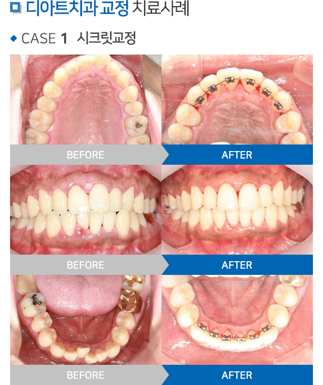교정치료 설명 01