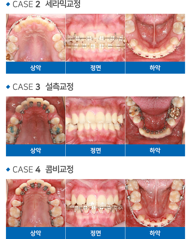 교정치료 설명 02