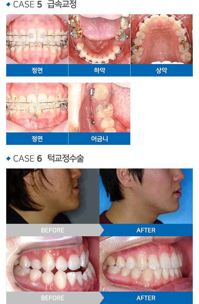 교정치료 설명 03